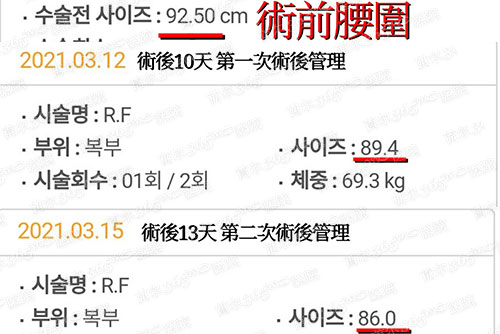 韩国365mc医院抽脂前后尺寸图