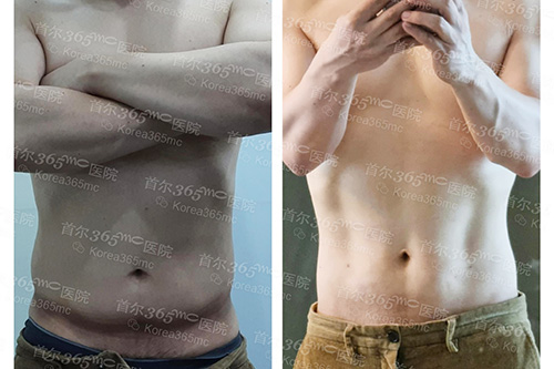 韩国365mc医院男性吸脂对比图