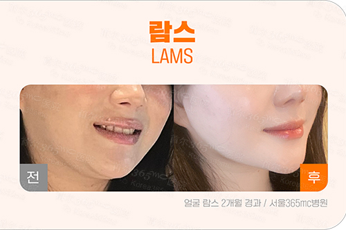 韩国365mc医院面部lams吸脂术后照片