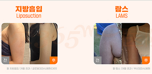 韩国365mc医院手臂抽脂术后照片