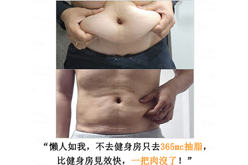 韩国365mc医院男士腰腹吸脂术前术后对比图