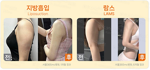 韩国365mc医院手臂吸脂手术前后对比图