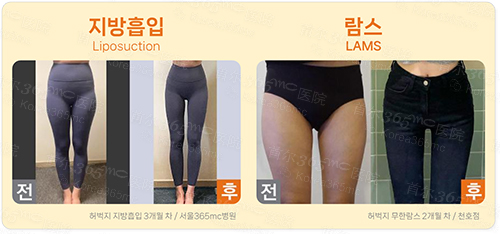 韩国365mc医院大腿吸脂手术前后对比图