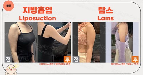 韩国365mc医院手臂吸脂对比图
