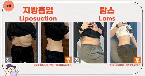 韩国365mc医院腰腹吸脂对比图