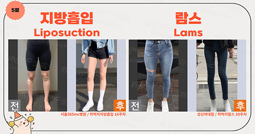 韩国365mc医院腿吸脂对比图