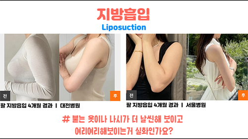 韩国365mc医院手臂吸脂术后分享照片