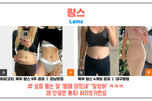 韩国365mc医院腰腹lams吸脂前后对比照片