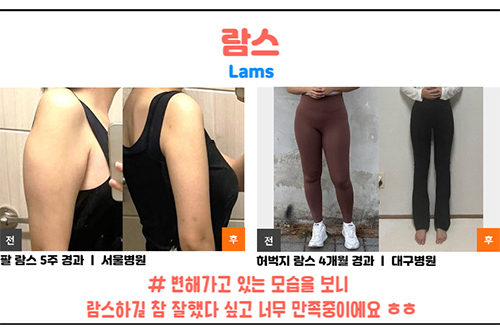 韩国365mc医院手臂和大腿lams吸脂前后对比照片
