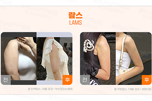 韩国365mc医院手臂lams吸脂8月高分对比照片