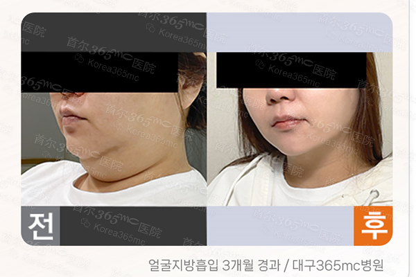 韩国365mc医院面部吸脂对比图