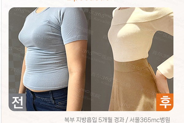 韩国365mc医院腰腹环吸手术对比图