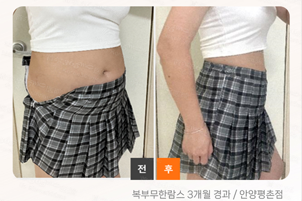 韩国365mc医院腰腹环吸lams对比图