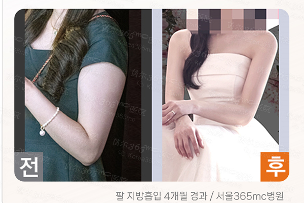 韩国365mc医院手臂抽脂手术对比图
