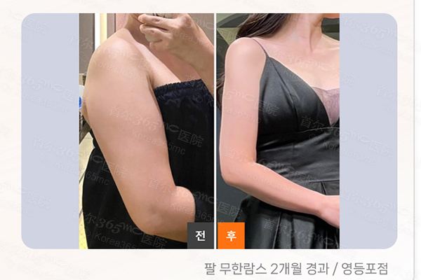 韩国365mc医院手臂抽脂lams对比图