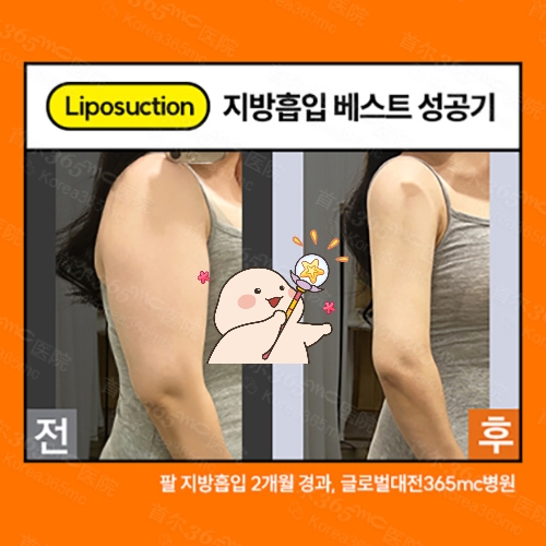 韩国365mc医院手臂吸脂手术前后对比图