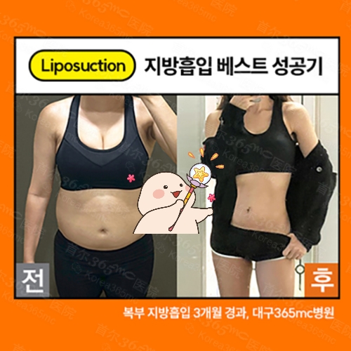 韩国365mc医院腰腹吸脂手术前后对比图