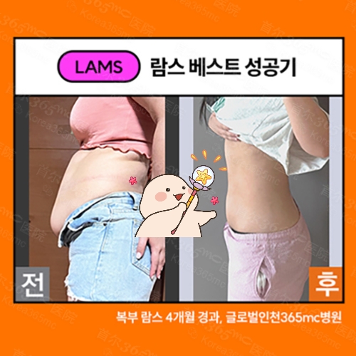 韩国365mc医院兰斯腹部吸脂前后对比图
