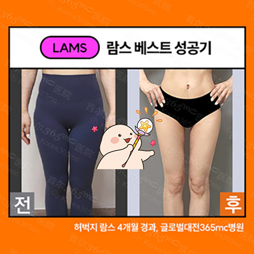 韩国365mc医院兰斯大腿吸脂前后对比图