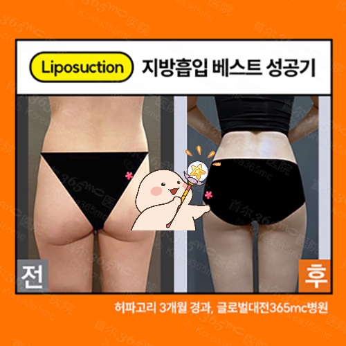 韩国365mc医院细腰蜂臀手术前后对比图