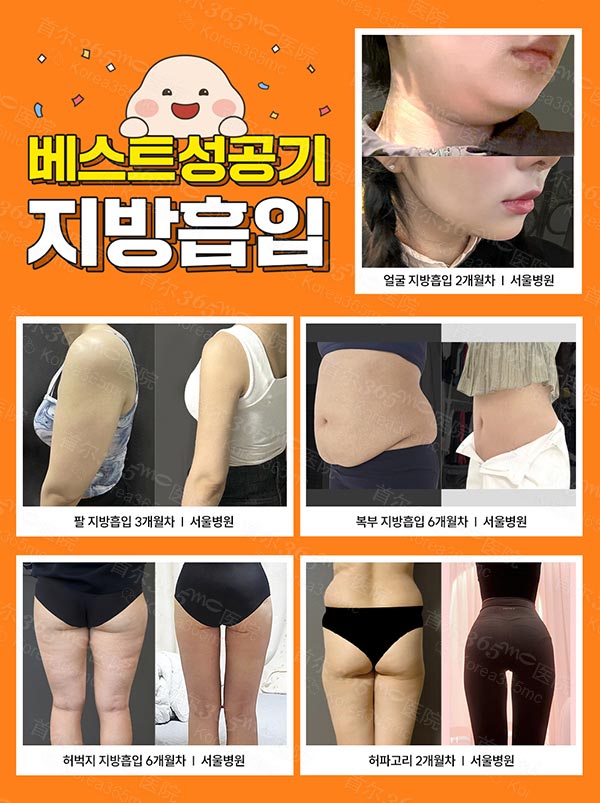 韩国365mc医院抽脂手术前后对比图