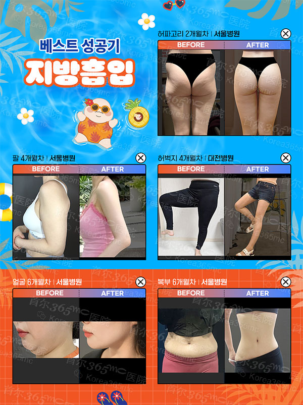 韩国365mc医院吸脂手术前后对比图