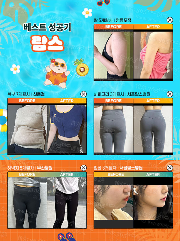 韩国365mc医院兰斯吸脂前后对比图