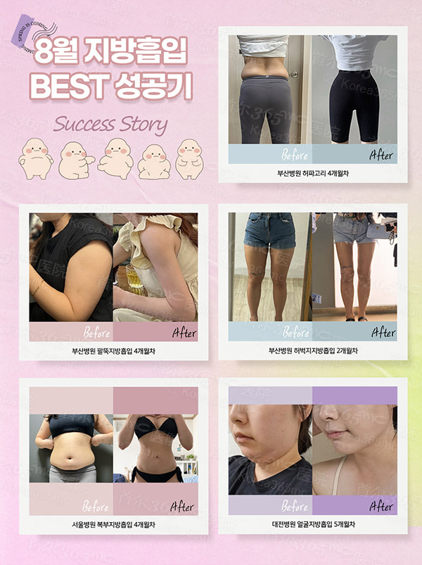韩国365mc医院前后对比图