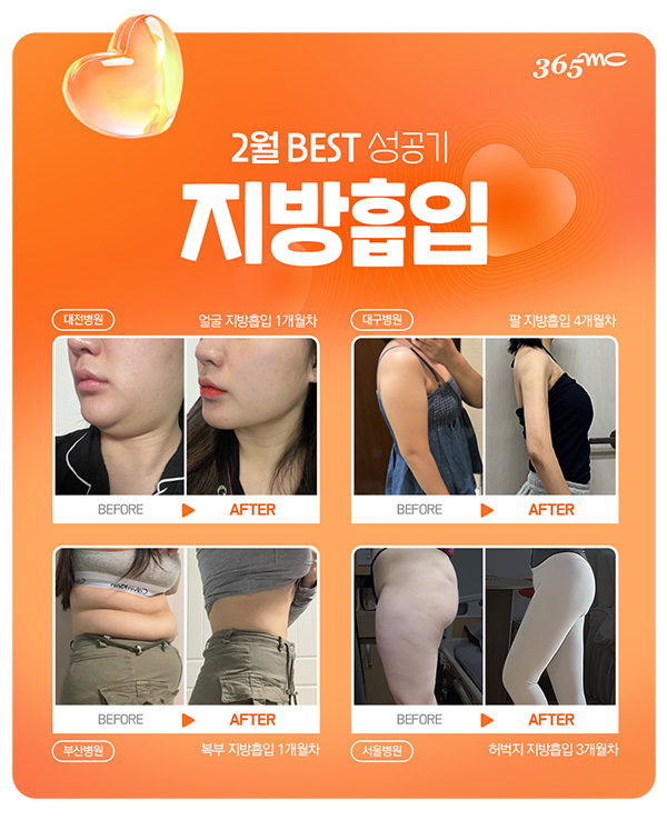 韩国365mc医院2月抽脂前后对比