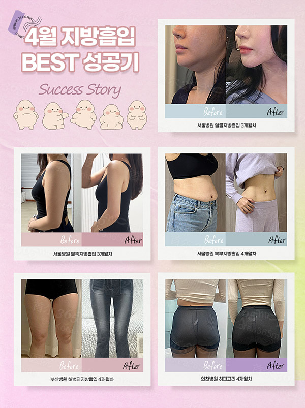 韩国365mc医院手术吸脂前后对比案例