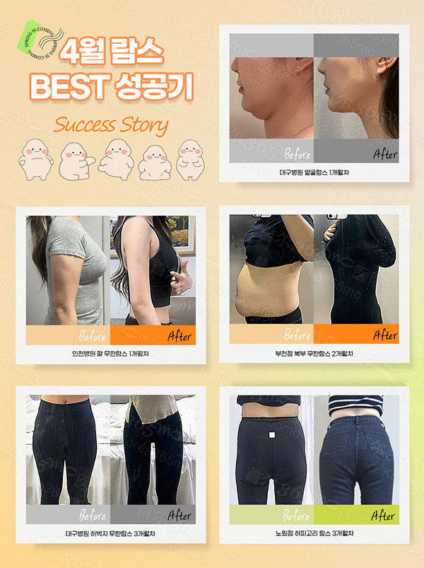 韩国365mc医院4月兰斯抽脂前后对比