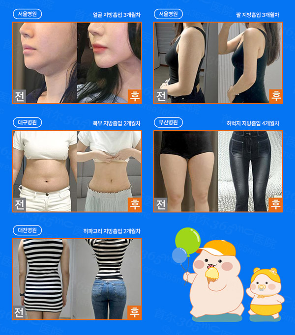 韩国365mc医院5月吸脂手术前后对比图