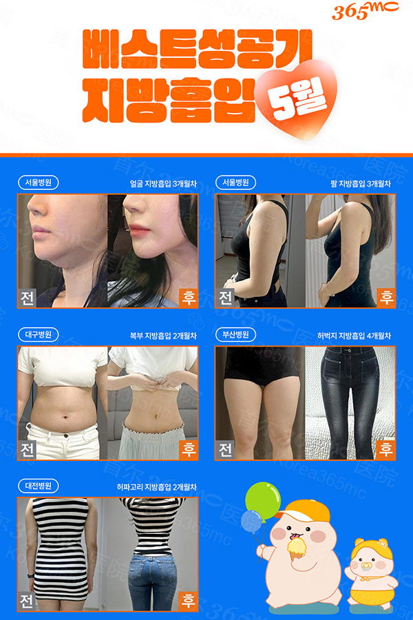 韩国365mc医院吸脂手术前后对比图