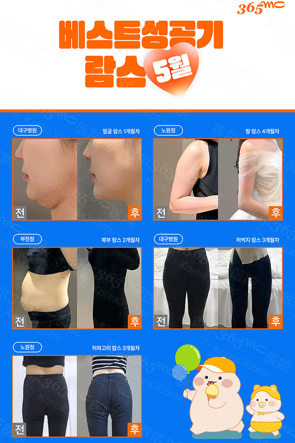 韩国365mc医院LAMS吸脂前后对比图