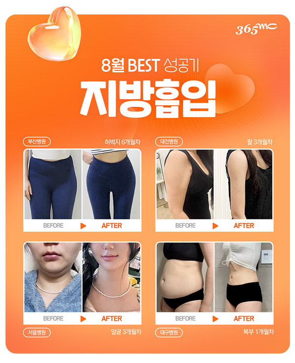 韩国365mc医院吸脂手术案例